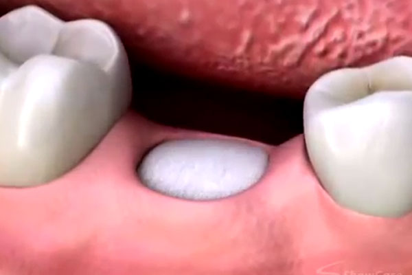 Tooth Extractions