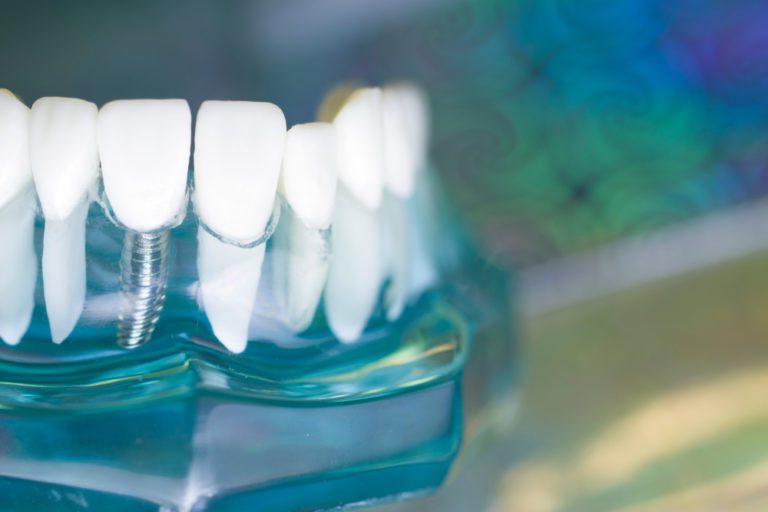 A Brief Guide to Dental Implant Surgery