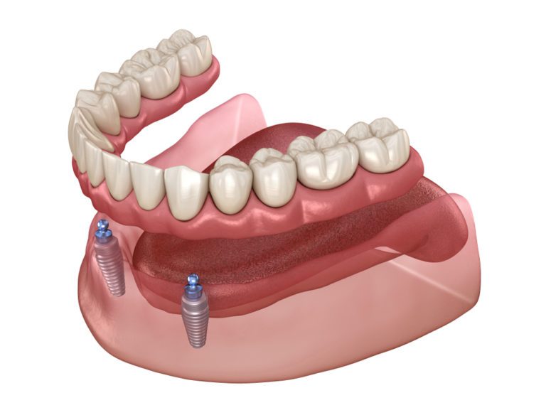 All-On-4 Versus Dentures