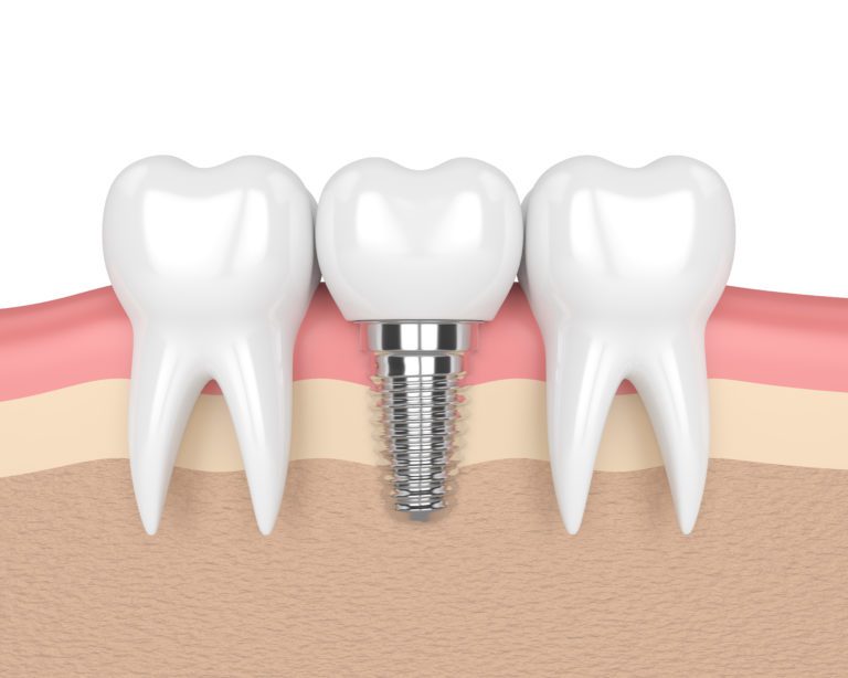 Fix Your Failing Dentition